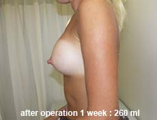 plastic-surgery-breast-augmentation 